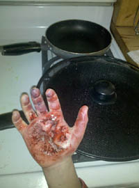 Burnt Hand - Jodi Byrne Special FX Makeup Artist